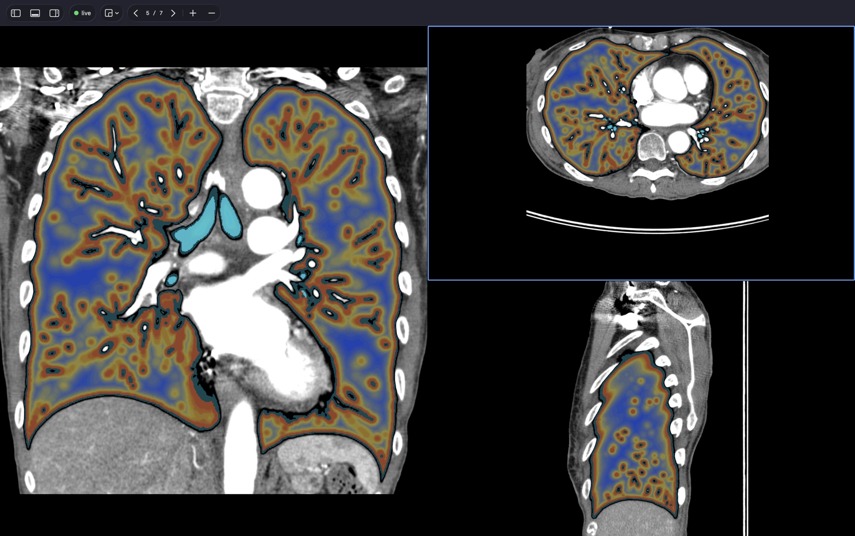 A chest CT in three planes with a computed tissue model rendered over the lungs