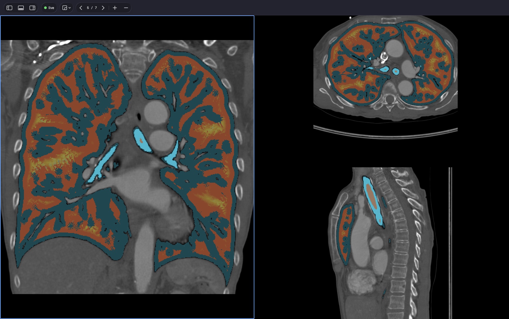 The Melkorka Viewer showing a chest CT in three planes with a computed tissue model rendered over the lungs